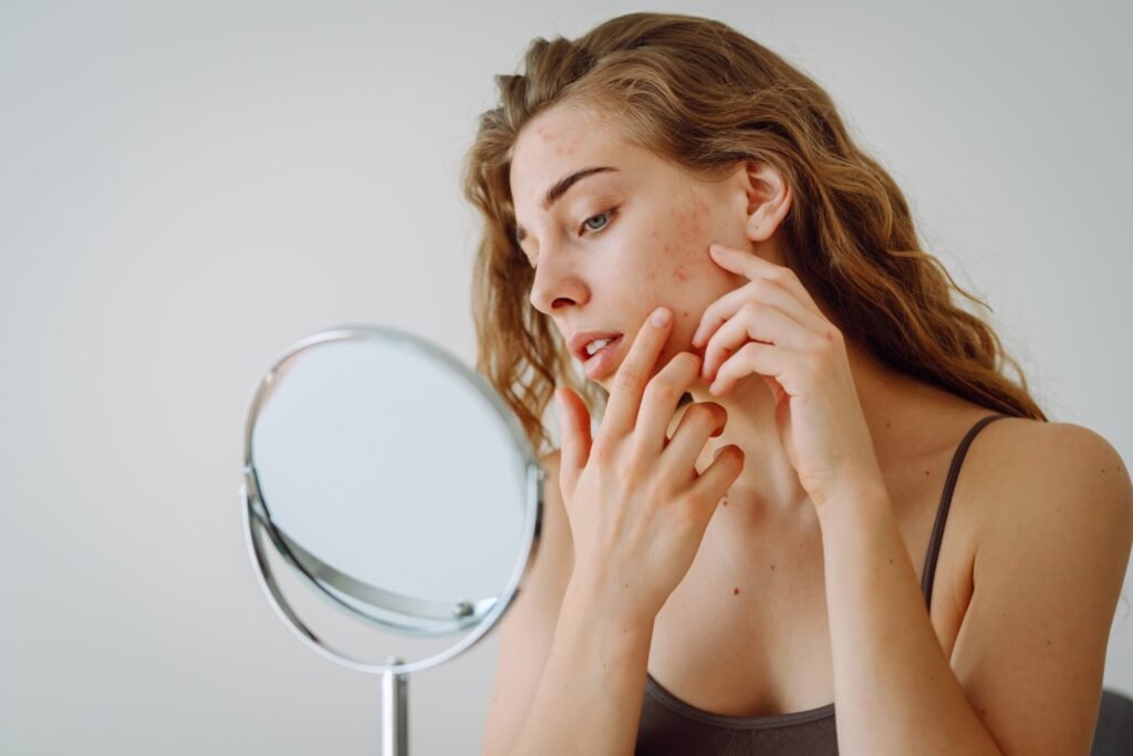 Le cause nascoste dell’acne: quello che forse non sapevi