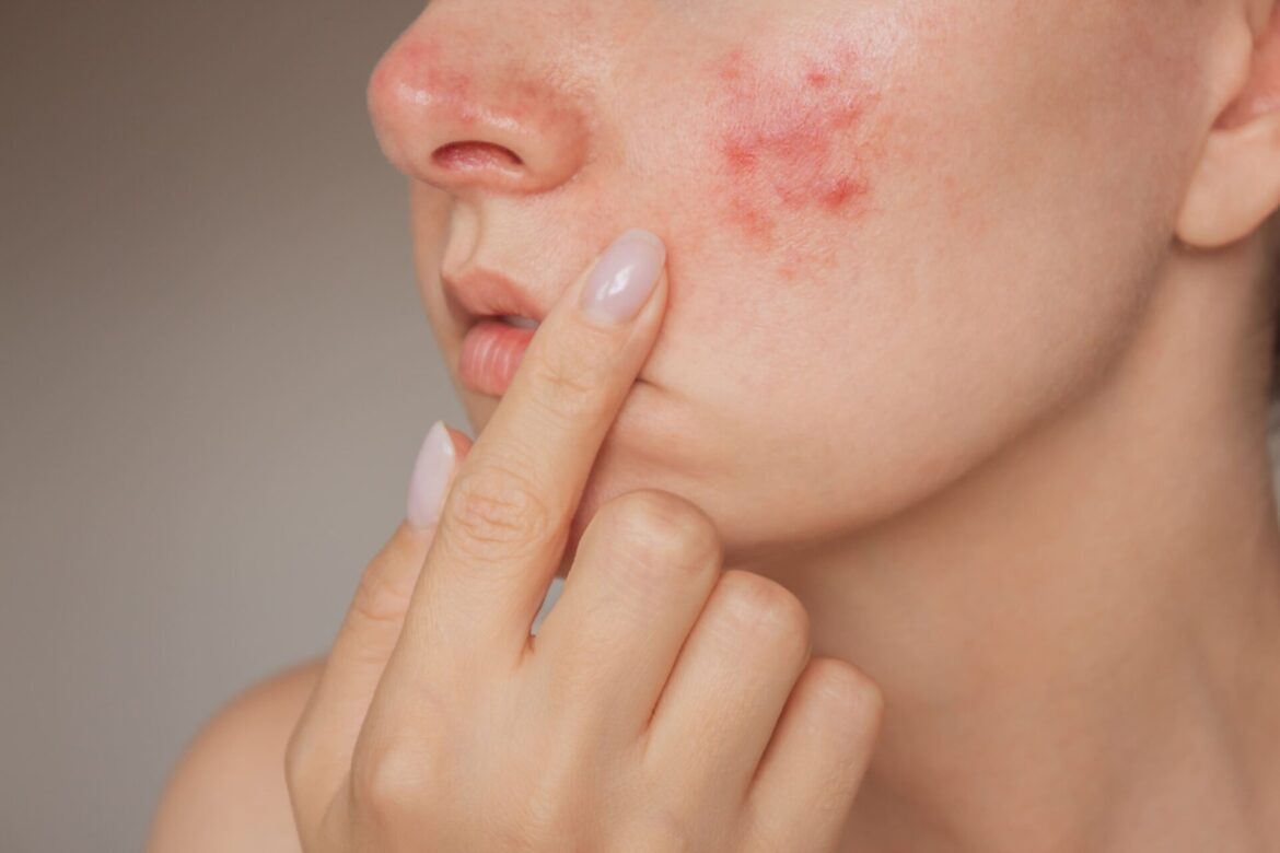 Peau sensibilisée